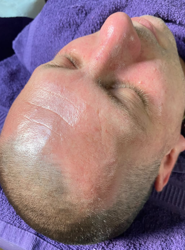 Skin immediately after a facial treatment at Kat's Beauty